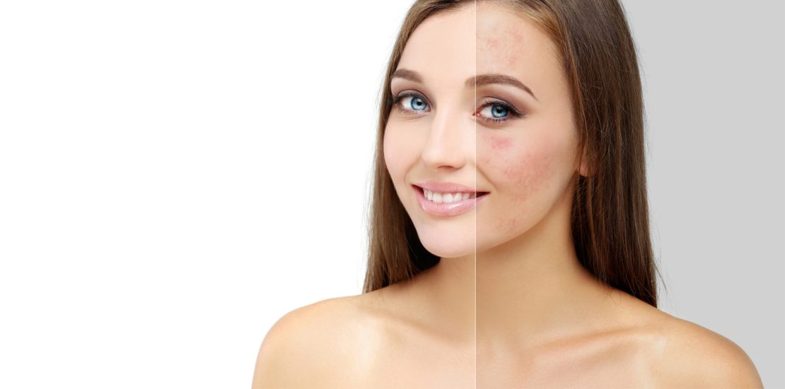 Acne scars1-efa68dc3-f0dd-4f59-abda-f37b5ed2d5bd