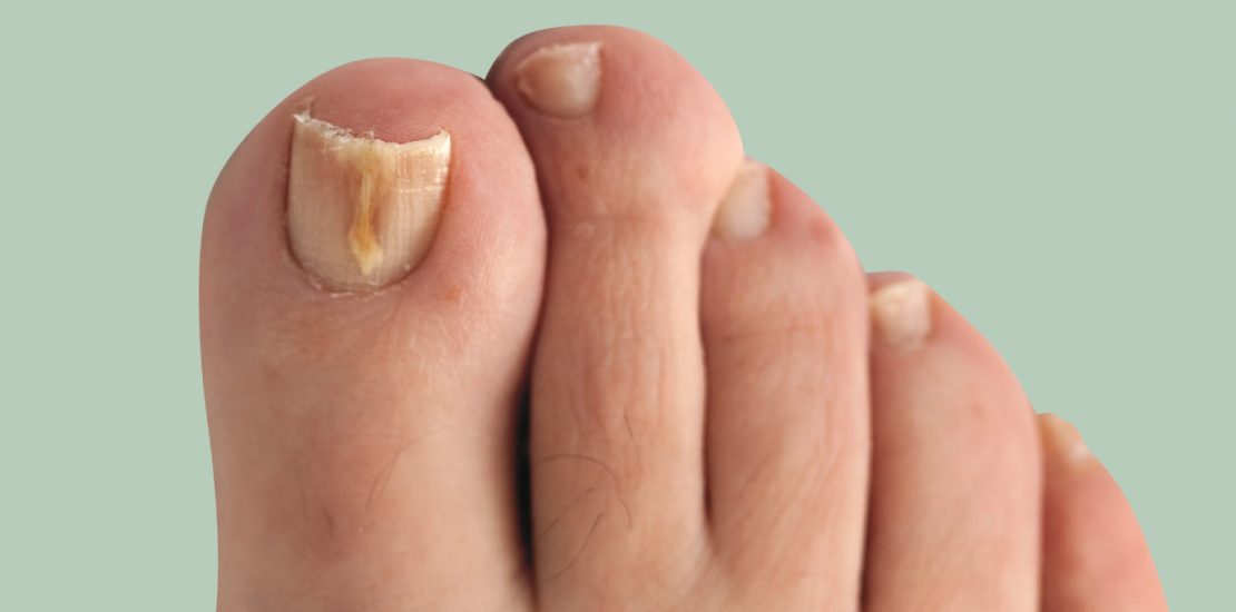 fungal-nail-lead-18-ea86ffef-69ea-4ffc-b89f-bb0de3e07fb8